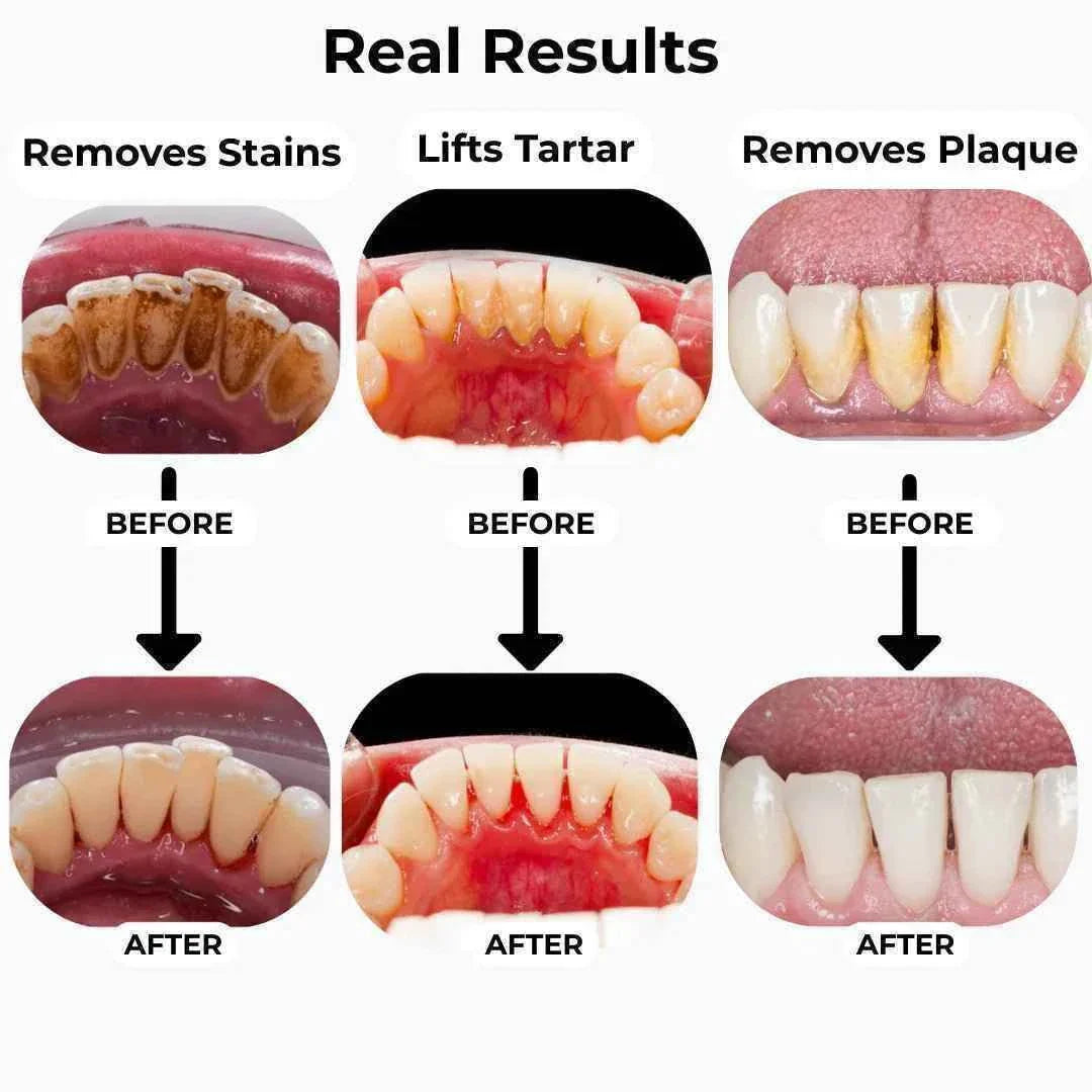 T7 Ultrasonic Tooth Cleaner | Advanced Plaque & Tartar Removal
